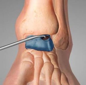 Lesioni osteo cartilaginee 8 Lesioni osteo cartilaginee 8