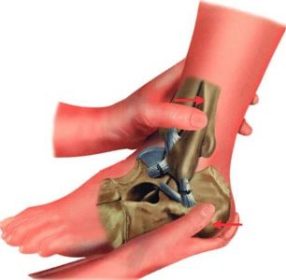 lesioni legamentose 4