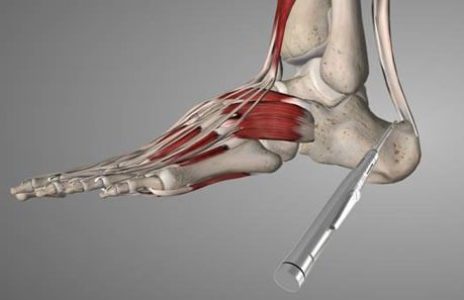 tendine achille 10 tendine achille 10