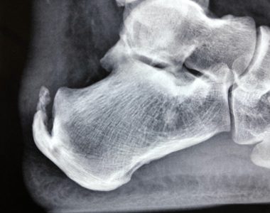 tendine achille 4 tendine achille 4