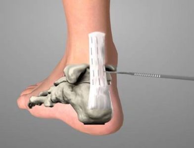 tendine achille 7 tendine achille 7