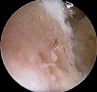 tendine achille 9 tendine achille 9